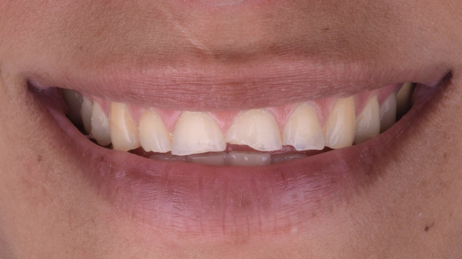 Un sorriso prima del trattamento restauro in composito